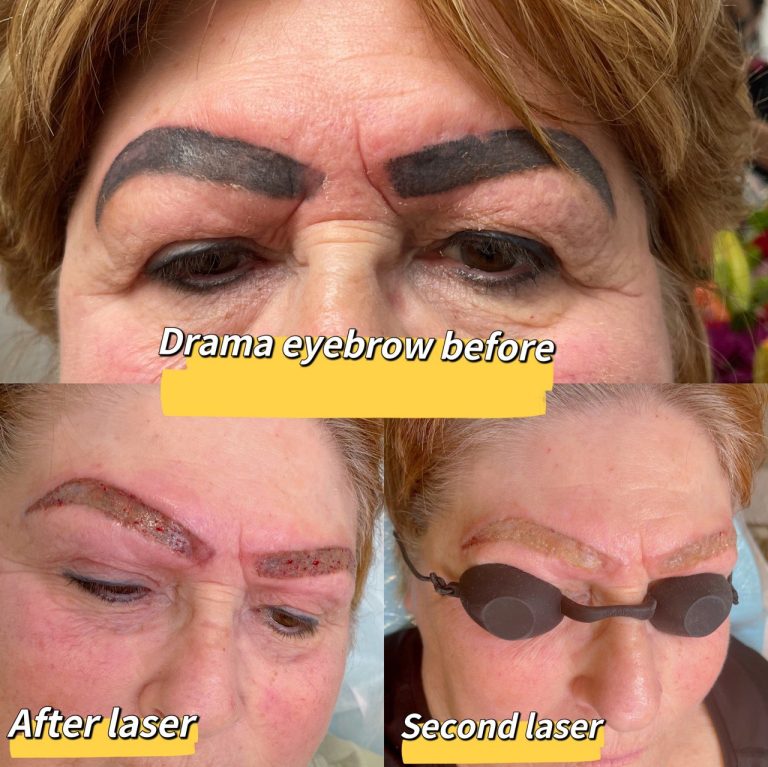 Fixing eyebrows1